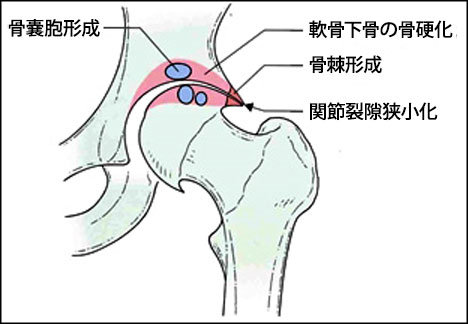 傷ついた股関節